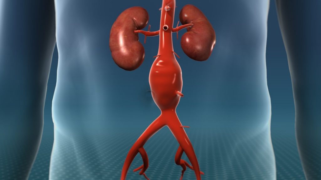 What Is Aortic Aneurysm?