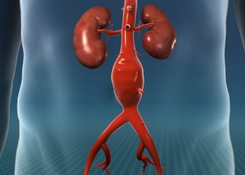 What Is Aortic Aneurysm?