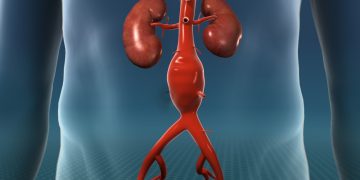 What Is Aortic Aneurysm?