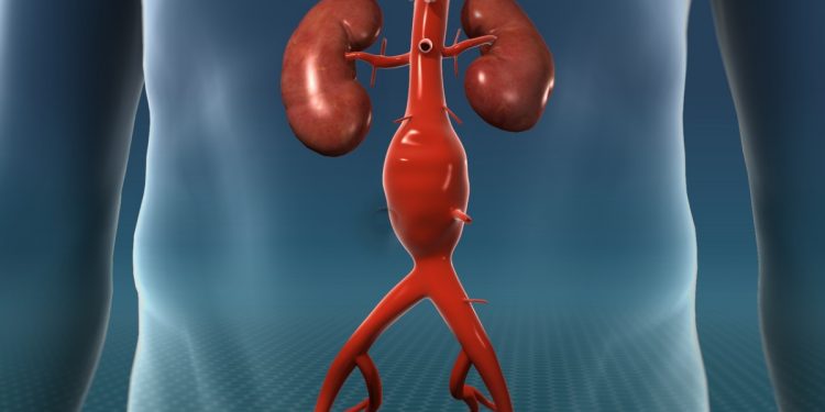 What Is Aortic Aneurysm?