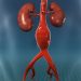 What Is Aortic Aneurysm?